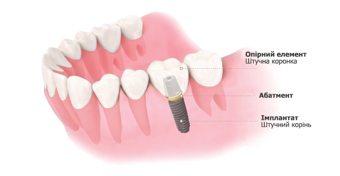 detailimplant